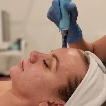 Microneedling pen treatment on the forehead at Radiance Medspa in Vinings, Atlanta