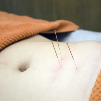 Acupuncture needles placed along facial meridian points during a session