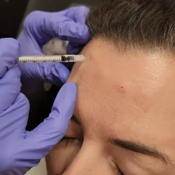 Botox injection in the forehead area to treat the 11s between the brows at Radiance Medspa