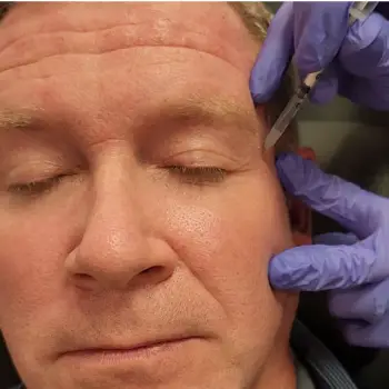 Botox injection near the crow's feet area at Radiance Medspa