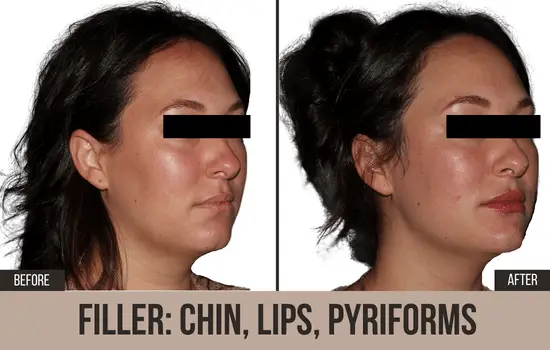 dermal filler before and after