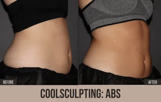 CoolSculpting before after