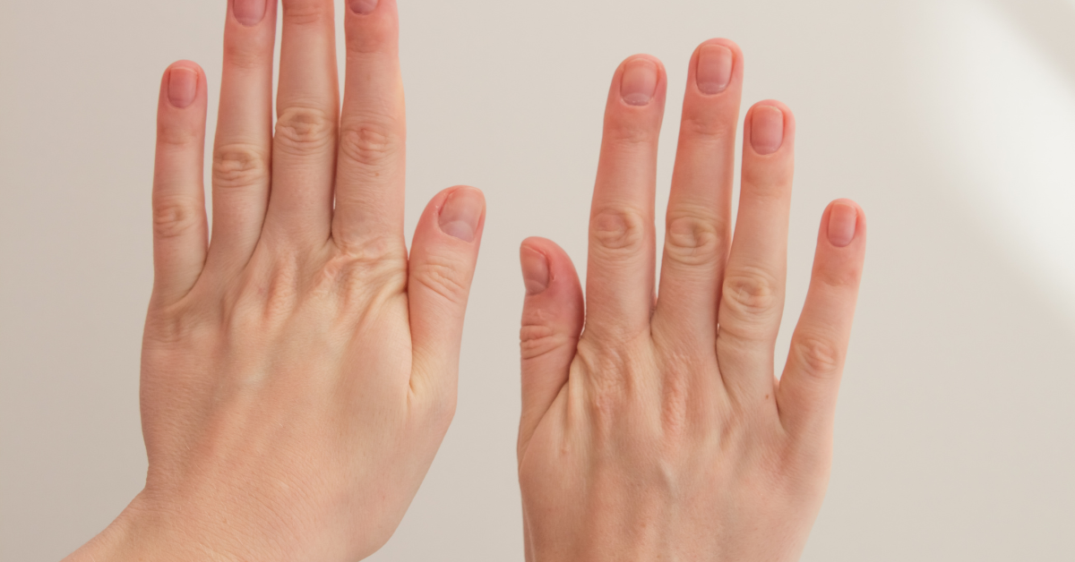 Hand rejuvenation treatment at Radiance Medspa in Atlanta