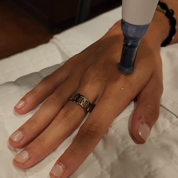 Hand rejuvenation treatment at Radiance Medspa in Atlanta