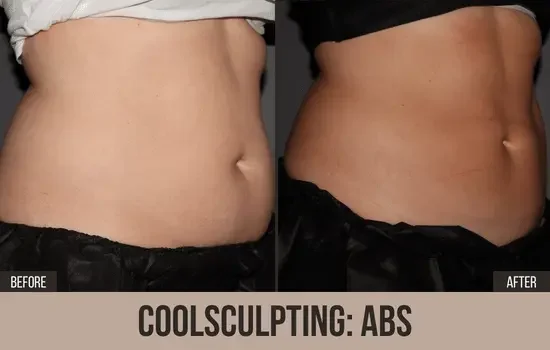 coolsculpting before and after