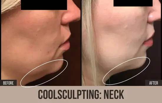 before-after-coolsculpting-11