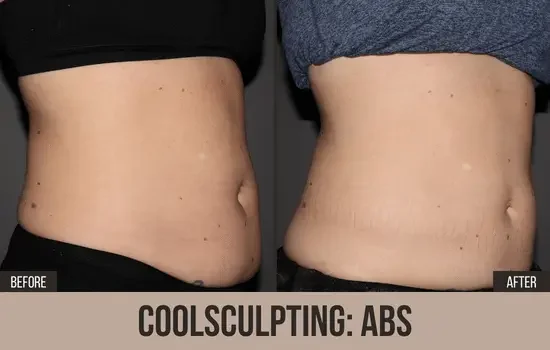 coolsculpting before and after