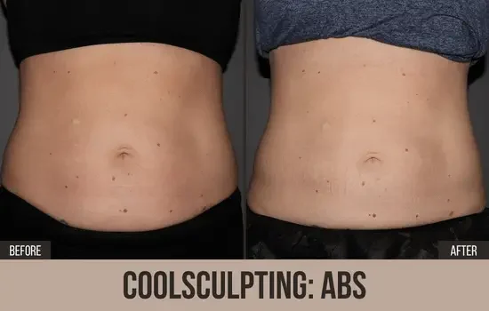 coolsculpting before and after