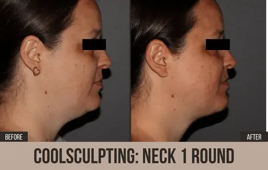 coolsculpting before and after