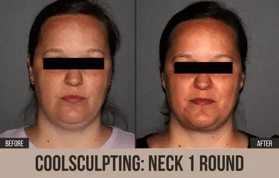 coolsculpting before and after