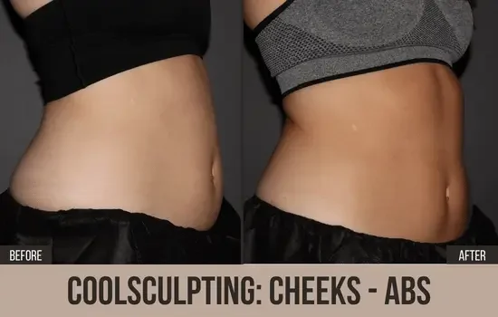 coolsculpting before and after