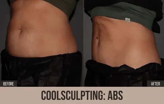 coolsculpting before and after