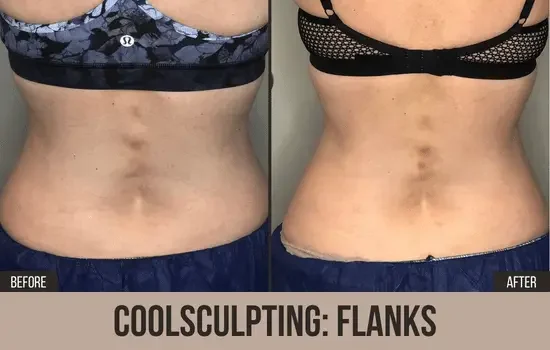 coolsculpting before and after