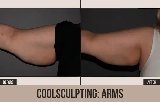 coolsculpting before and after