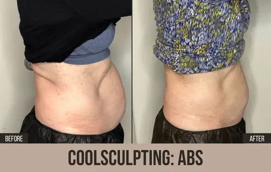 coolsculpting before and after