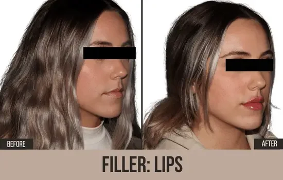 dermal filler before and after