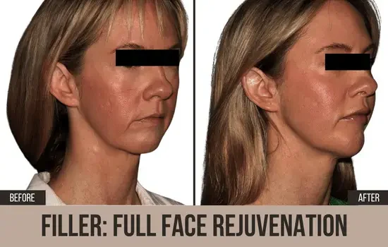 dermal filler before and after