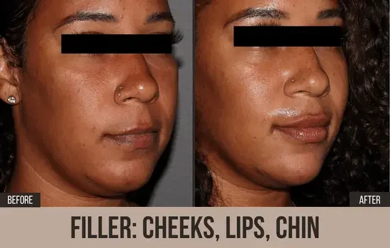 dermal filler before and after